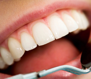 Fillings, Inlays & Onlays in Bournemouth | Charminster House