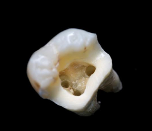 Root Canal Treatment in Bournemouth | Save Natural Teeth